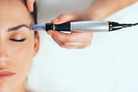 A woman receiving a professional facial microneedling treatment with a dermapen on her forehead.
